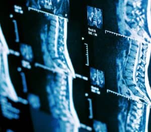 spinal cord injury